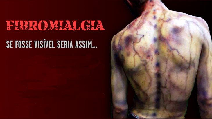 Comissão inclui fibromialgia no rol de doenças com dispensa de carência para auxílio-doença
